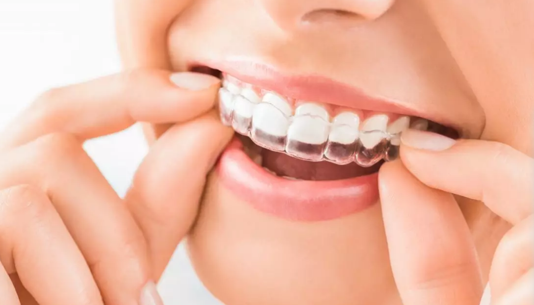 Risultati dello sbiancamento